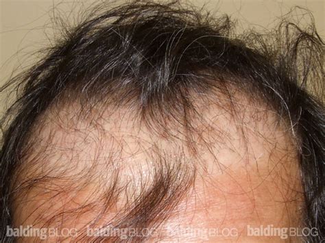 Unnatural Looking Balding Pattern (with Photos) – WRassman,M.D. BaldingBlog