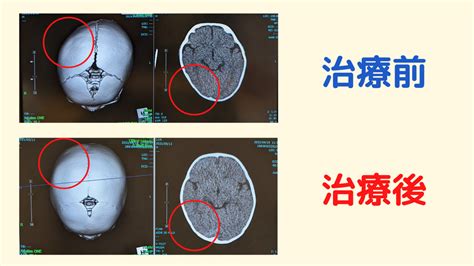 【あかちゃんの頭の形矯正】ヘルメット治療〜着用時間と夏場の注意点〜