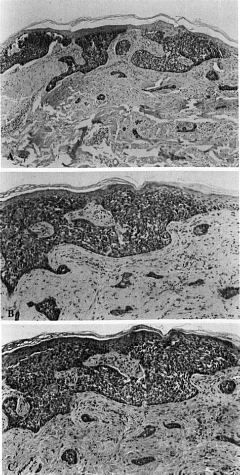 Immunohistochemical Nuclear Staining For P Pcna And Ki In