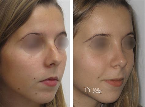 Rinoplastia Clínica do Nariz e Face Especialistas em face