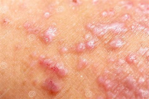 Atopic Dermatitis Ad Also Known As Atopic Eczema Is A Type Of