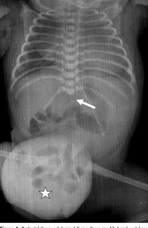 Figure From Prenatal Diagnosis Of Caudal Regression Syndrome And