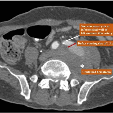 Computed Tomography Angiography Cta Of Abdomen Axial View Shows