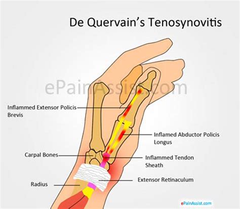 Dequervain S Tenosynovitis Causes Symptoms Treatments Physiotherapy