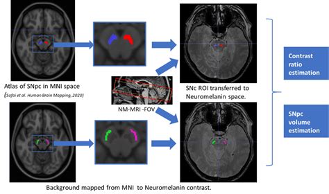 Characterization Of Neuromelanin Mri As A Potential Parkinsons Disease Biomarker In A Multi