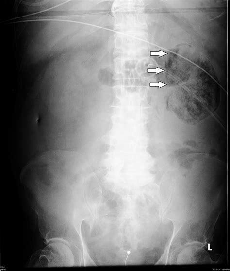 Emphysematous Pyelonephritis Outcomes Of Conservative Management And Literature Review Bmj