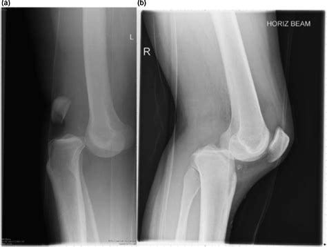 Epidemiology And Outcomes Of Traumatic Knee Dislocations Isolated Vs