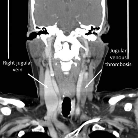 Follow The Lead Internal Jugular Vein Thrombosis The American