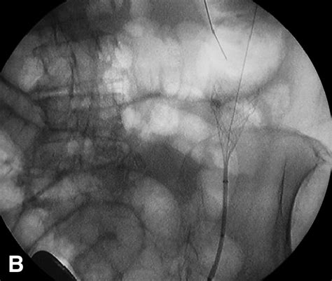 Wallflex Colonic Stent Placement For Management Of Malignant Colonic