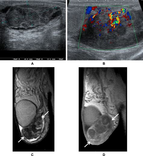 Imaging Features Of Paratesticular Masses Secil 2017 Journal Of