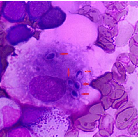Wright Stain Finding Of Bone Marrow Smear Demonstrated Intracellular