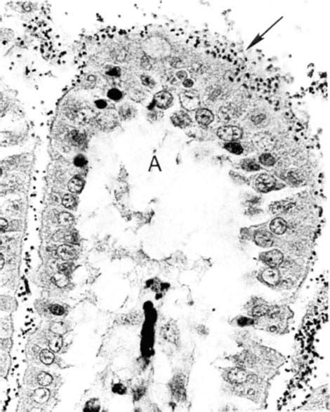 Fig L Gram Positive Cocci Arrow Adhered To Apical Surfaces Of Download Scientific Diagram