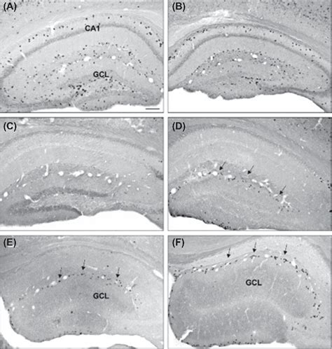 Epilepsy Associated Reelin Dysfunction Induces Granule Cell Dispersion