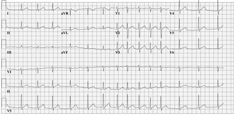 File:Afib ecg.jpg - ECGpedia