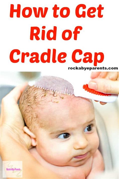 How To Get Rid Of Cradle Cap 6 Different Treatments To Try