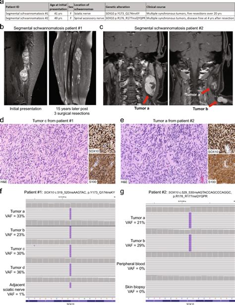 体细胞嵌合 SOX10 插入缺失突变是节段性神经鞘瘤病的基础 Acta Neuropathologica X MOL