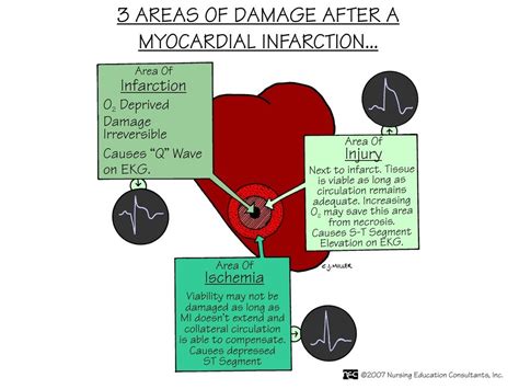 Myocardial Infarction Nursing Mnemonics Medical Surgical Nursing