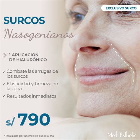 Surcos Nasogenianos