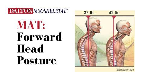 Forward Head Posture Neck Hump