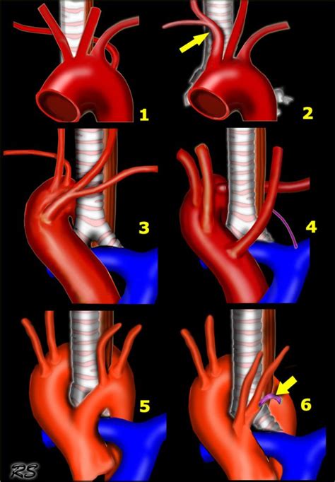 Right Aortic Arch With Aberrant Left Subclavian