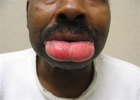 Lupus Lips Swelling Lipstutorial Org