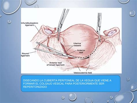 CirugÍas Obstetricas Y GinecolÓgicas Ppt