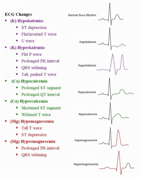 Ecg Interpretation Review 13 Bbb Wide Qrs Is This Lbbb Vs Rbbb Vs Ivcd Artofit