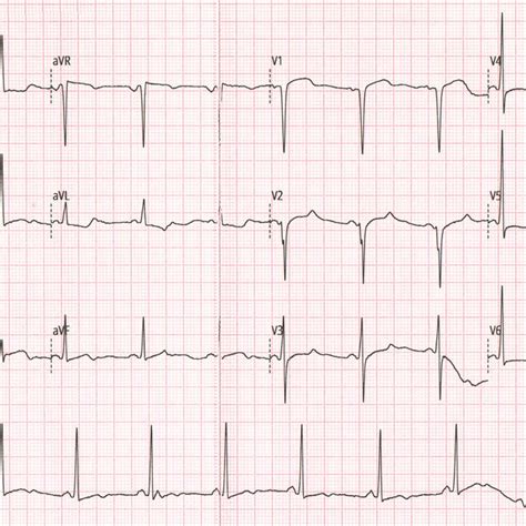 The Ecg Of The Following Days Showed The St‐segment Depression Was