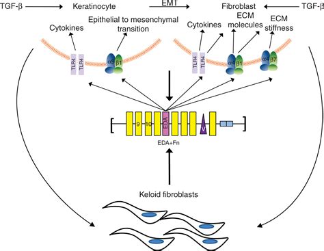 EDA Fibronectin In Keloids Create A Vicious Cycle Of Fibrotic Tumor