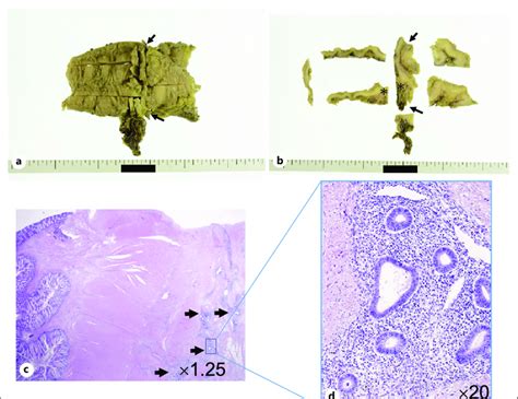 Pathological Findings A B Macroscopic Findings In The Resected Rectal