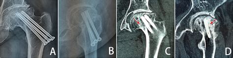 Radiographic data of a clinical femoral neck fracture case. A Coronal... | Download Scientific ...