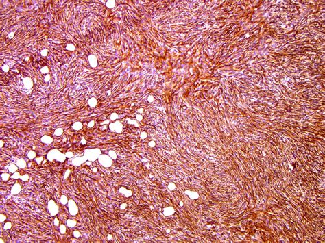 Pathology Outlines Dermatofibrosarcoma Protuberans Dfsp