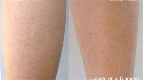 What To Expect With Laser Hair Removal Hot Sale