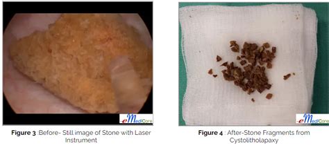 Bladder Stone Removal Cystolitholapaxy