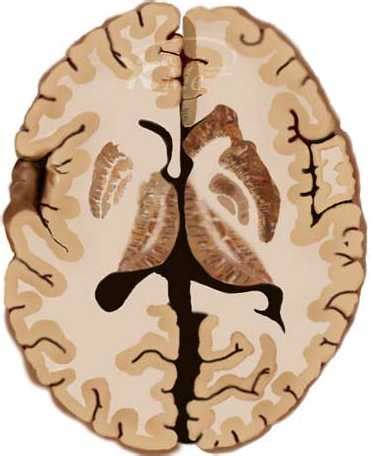 Brain (malignant glioma) Tumors