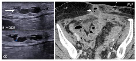 Diagnostics Free Full Text The Benign Side Of The Abdominal Wall A Pictorial Review Of Non