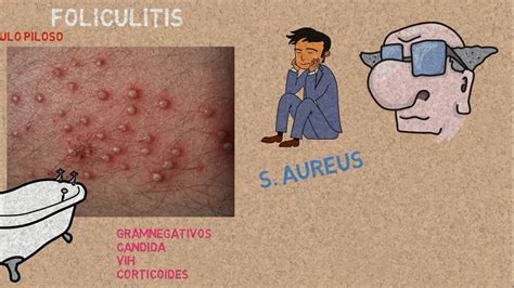 Foliculitis Youtube