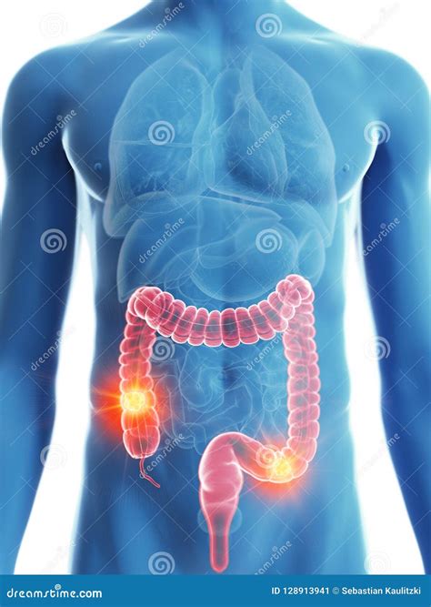 A Mans Colon Cancer Stock Illustration Illustration Of Body 128913941