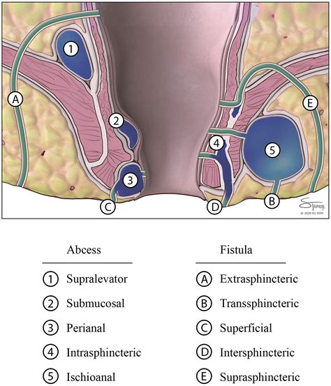 Infant Anorectal Abscess