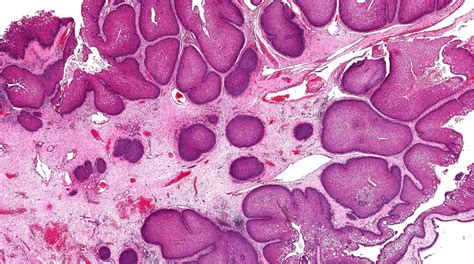 Pathology Outlines Sinonasal Papilloma | SexiezPicz Web Porn