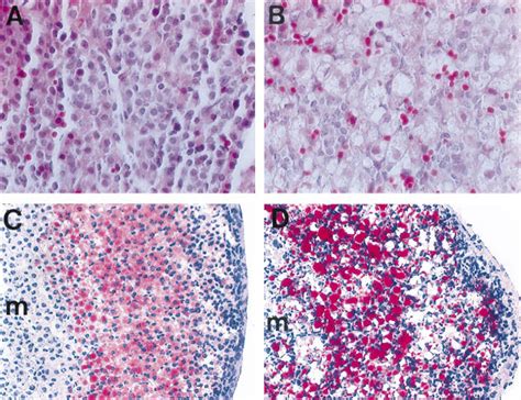 Congenital Adrenal Hyperplasia Histology