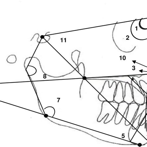 Angular Cephalometric Measurements 1 Sna 2 Snb 3 Anb 4 1 Pal 5 Download Scientific