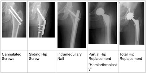 Hip Fracture Dr Jonathan R Danoff Md Orthopedic Surgeon