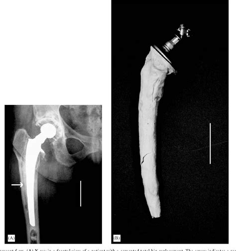 Figure From Backgrounds Of Antibiotic Loaded Bone Cement And