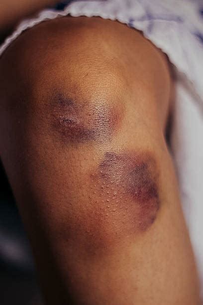 Best Bruise Stock Photos, Pictures & Royalty-Free Images - iStock