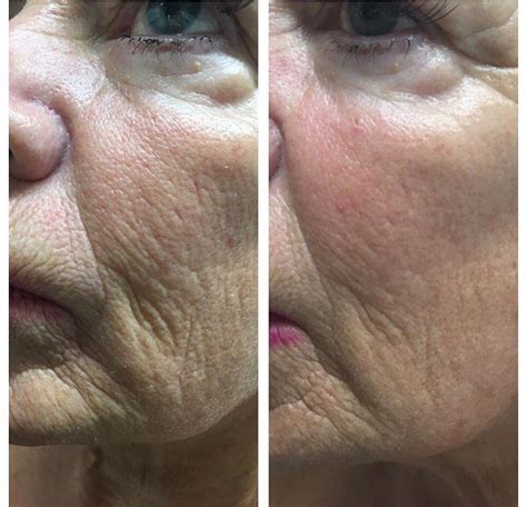 Before And After Gallery Cincinnati Neogen Plasma Skin Regeneration
