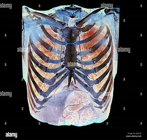 Healthy rib cage, CT scan Stock Photo - Alamy