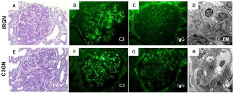 Diffuse Proliferative Glomerulonephritis Em
