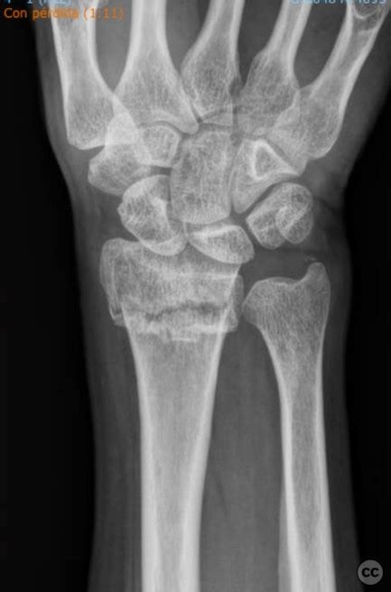 Distal Radius Fracture Osteosynthesis