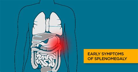 Splenomegaly Enlarged Spleen Symptoms Causes Treatment